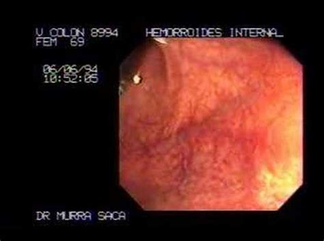 How To Do Proctoscopy To Diagnose Internal Hemorrhoids