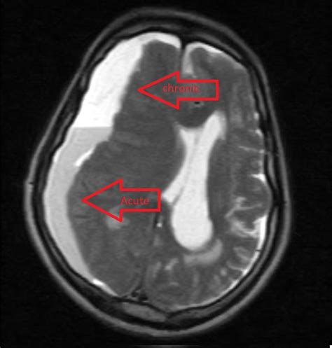 Subdural hematoma MRI - wikidoc