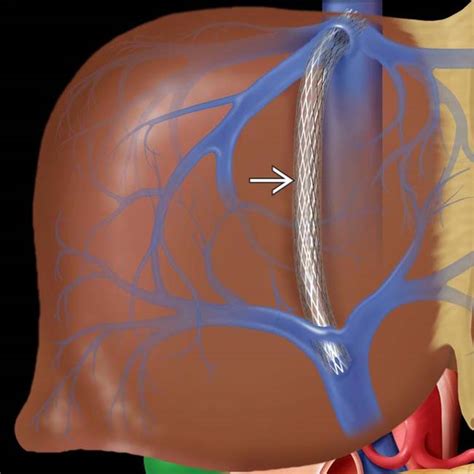 Download Portosystemic Shunt Surgery Images | Trendbilder