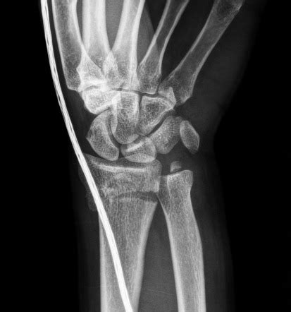 Frykman II distal radius fracture | Radiology Case | Radiopaedia.org