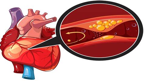 Recognizing the Signs: Unveiling Stage 4 Colon Cancer Symptoms | TheAmberPost