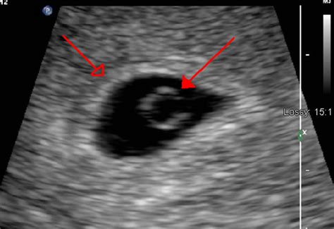 5 Week Gestational Sac Ultrasound