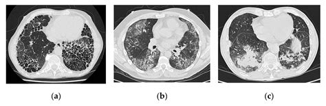 Rheumatoid Arthritis Interstitial Lung Disease - Pregnant Center Informations