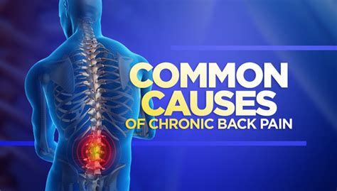 Common Causes of Chronic Back Pain | Kennedy Health Clinic