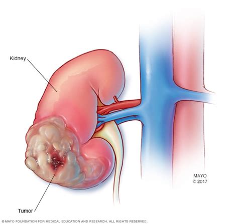 Kidney cancer - Symptoms and causes - Mayo Clinic