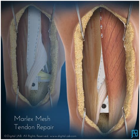 Marlex Mesh Repair Illustration by Digital JAB, LLC | Medical ...