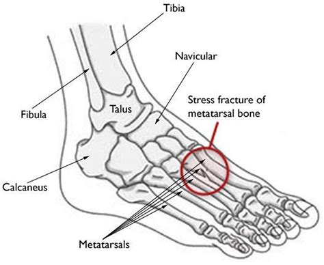 Broken Ankle - Fractured Ankle, Broken Foot, Stress Fracture Ankle