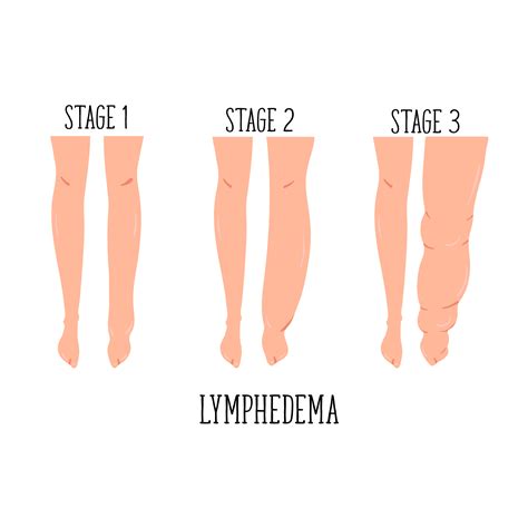 Guide to Lymphedema Treatment - PRN Home Health and Therapy