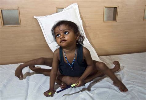 Body Bizarre – Episode 1Picture Shows: Lakshmi Tatma from India was born with a parasitic twin ...