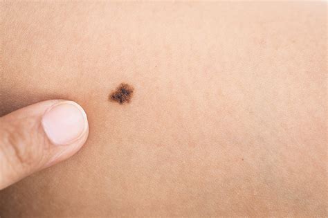 What Are Birthmarks? Types and Treatments | UPMC HealthBeat