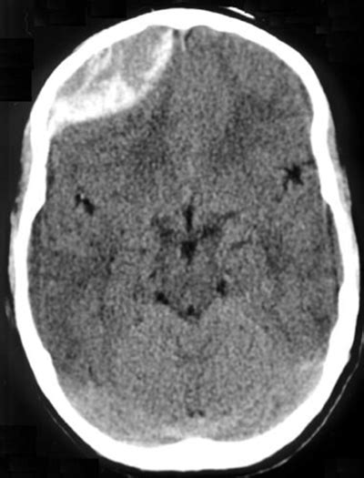 Epidural Hematoma Cross Suture Lines