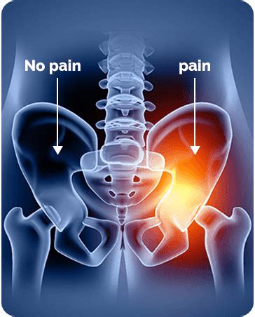 Pelvic Girdle Pain | Symptoms, Causes and Treatment | ANSSI