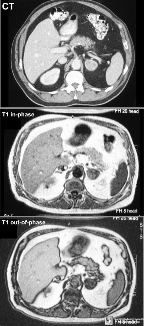 Learning Radiology Adrenal Adenoma Adrenal Glands, Adrenals, New ...