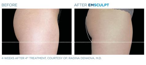 EMSCULPT Body Toning, Sculpting | DermPhysicians of New England