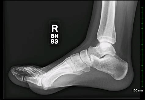 Archive Of Unremarkable Radiological Studies: Foot X-Ray - Stepwards