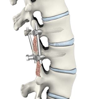 Spinal Fusion Surgery Sydney, NSW | Spinal Stenosis Treatment Kogarah, NSW