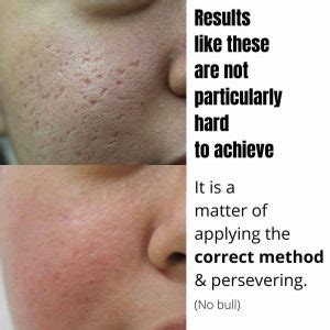 TCA Cross Acne Scars Treatment In Australia | Dr Davin Lim