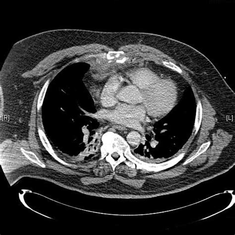 Sternum fracture | General center | SteadyHealth.com