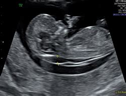 Nasal Bone Ultrasound