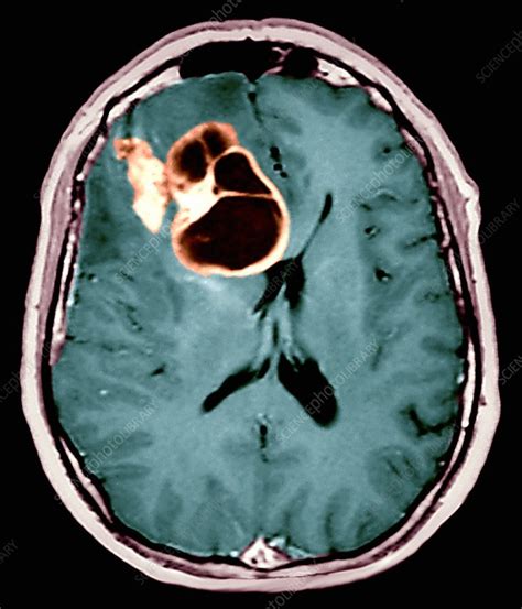 Brain cancer, MRI scan - Stock Image - M134/0469 - Science Photo Library