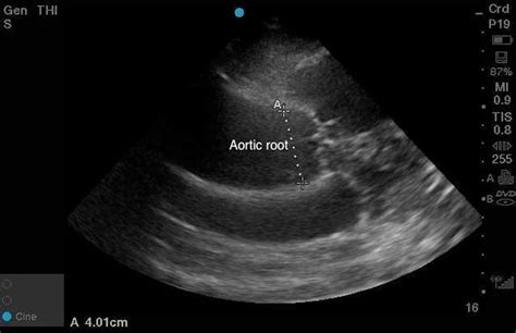 Aortic Dissection Ultrasound