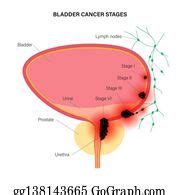 100 Bladder Cancer Stages Clip Art | Royalty Free - GoGraph