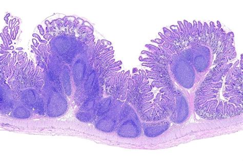 Severe COVID-19 found to be associated with disrupted intestinal Peyer’s patches