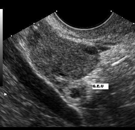 File:Ectopic pregnancy.JPG - Wikimedia Commons