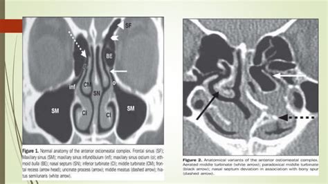 Surgical anatomy of osteomeatal complex | PPT