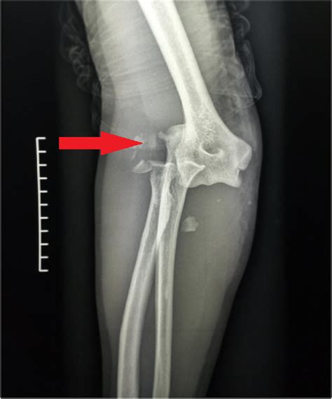 Standard X-ray of the elbow showing a terrible triad with type 2... | Download Scientific Diagram