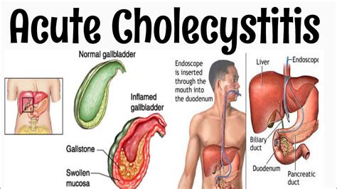 Acute Cholecystitis #Surgery #long_case #Viva #two_minutes_series - YouTube