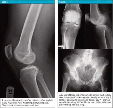 When X-Rays Lie: Important Orthopedic Diagnoses to Consider with Normal Imaging - Journal of ...