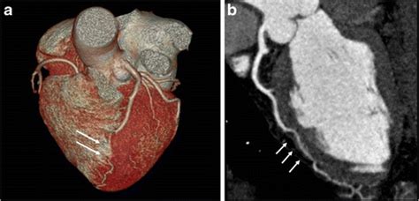 Mid LAD myocardial bridge seen in a VRR (white arrows) and b oblique ...