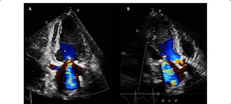 Case 4. Figure 2. Color Doppler echocardiography of A apical 2 chamber... | Download Scientific ...