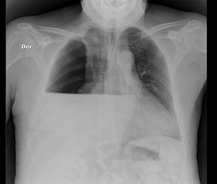 Hydropneumothorax | Radiology Case | Radiopaedia.org