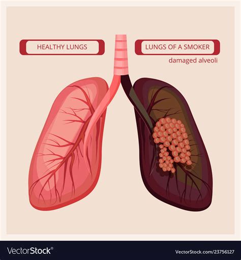 Chest X Ray Smokers Lungs