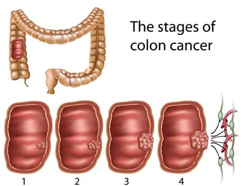 Color Of Stool With Colon Cancer - Infoupdate.org