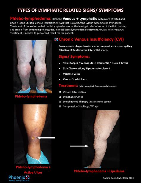 Lymphedema Treatment