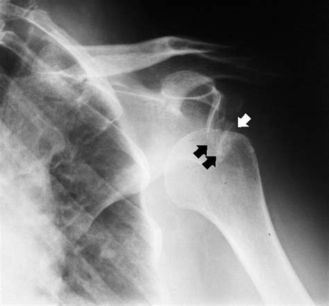 Glenohumeral Joint Arthritis