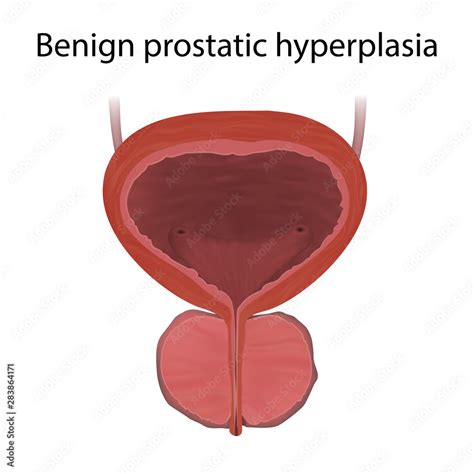 Benign prostatic hyperplasia, enlarged prostate. Realistic vector ...