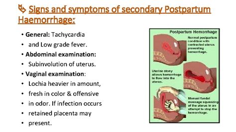 Postpartum Complications Postpartum hemorrhage Definition It is defined