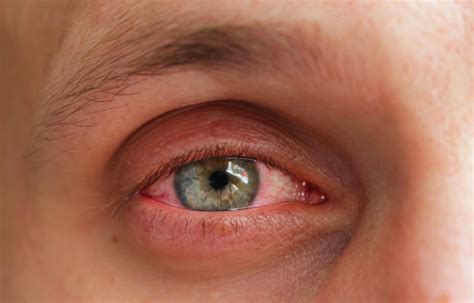 What Causes Eye Allergies, and How Are They Treated?