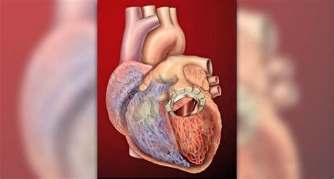 Complications after mitral valve replacement | General center ...