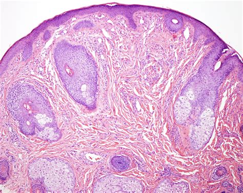 Fibrous Papule | Dermatopathology