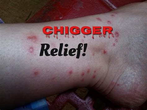 3 ways to treat chigger bites – Artofit