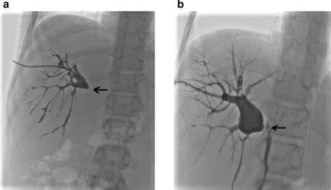 The images of percutaneous transhepatic cholangiography showing the... | Download Scientific Diagram