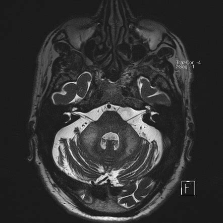 Middle cerebellar peduncle sign | Radiology Reference Article ...