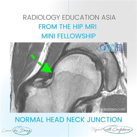 MRI HIP CAM FAI FEMORO ACETABULAR IMPINGEMENT - Radedasia