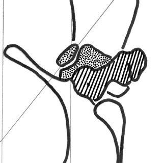 Example of a patient with squinting patella due to excess of tibial... | Download Scientific Diagram