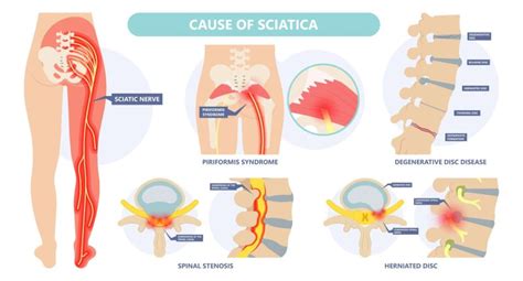 Sciatica & Low Back Pain, Sciatic Nerve, Sciatica Pain Treatment